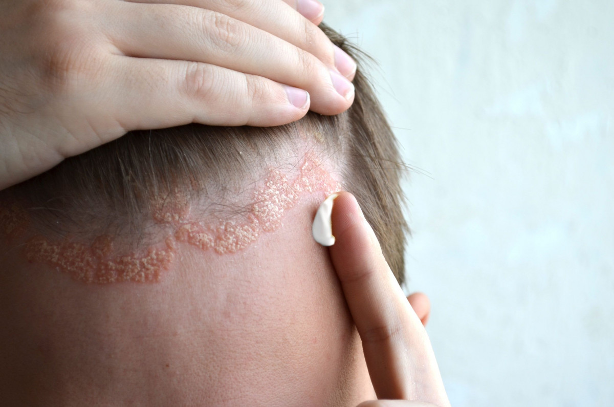 Psoriasis Kulit Kepala